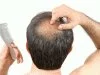 Выпадение волос может указывать на наличие рака простаты