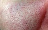 Как сузить крупные поры на лице - уход за кожей 