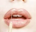 Пластическая хирургия губ