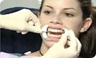 Кабинетные процедуры отбеливания зубов