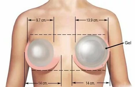 Увеличение груди: что нужно знать